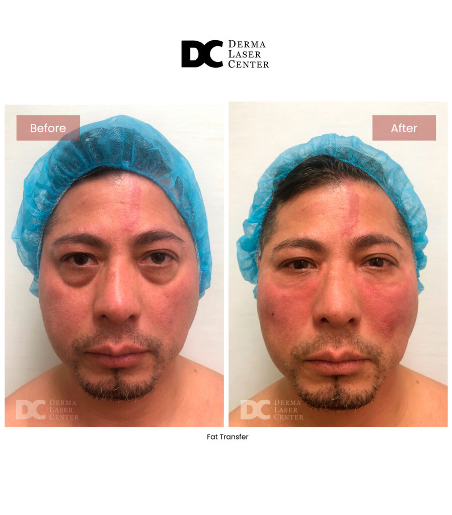 Fat transfer Image 65