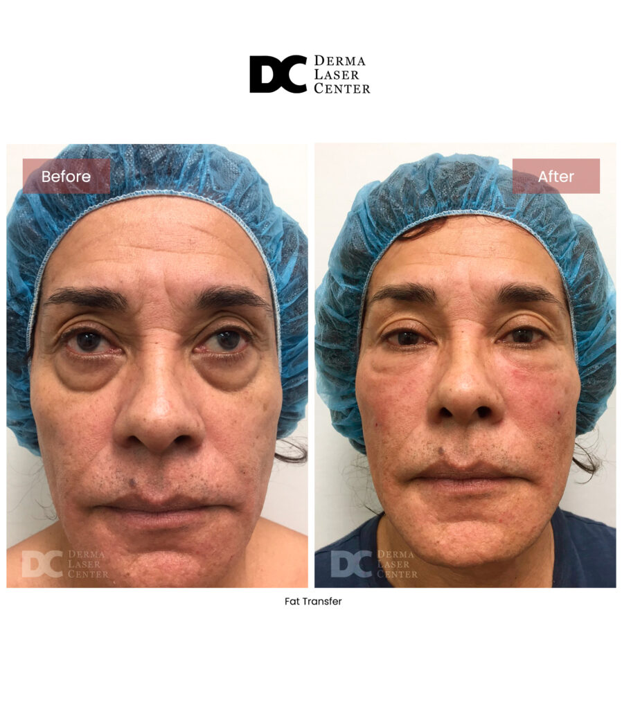 Fat transfer Image 68