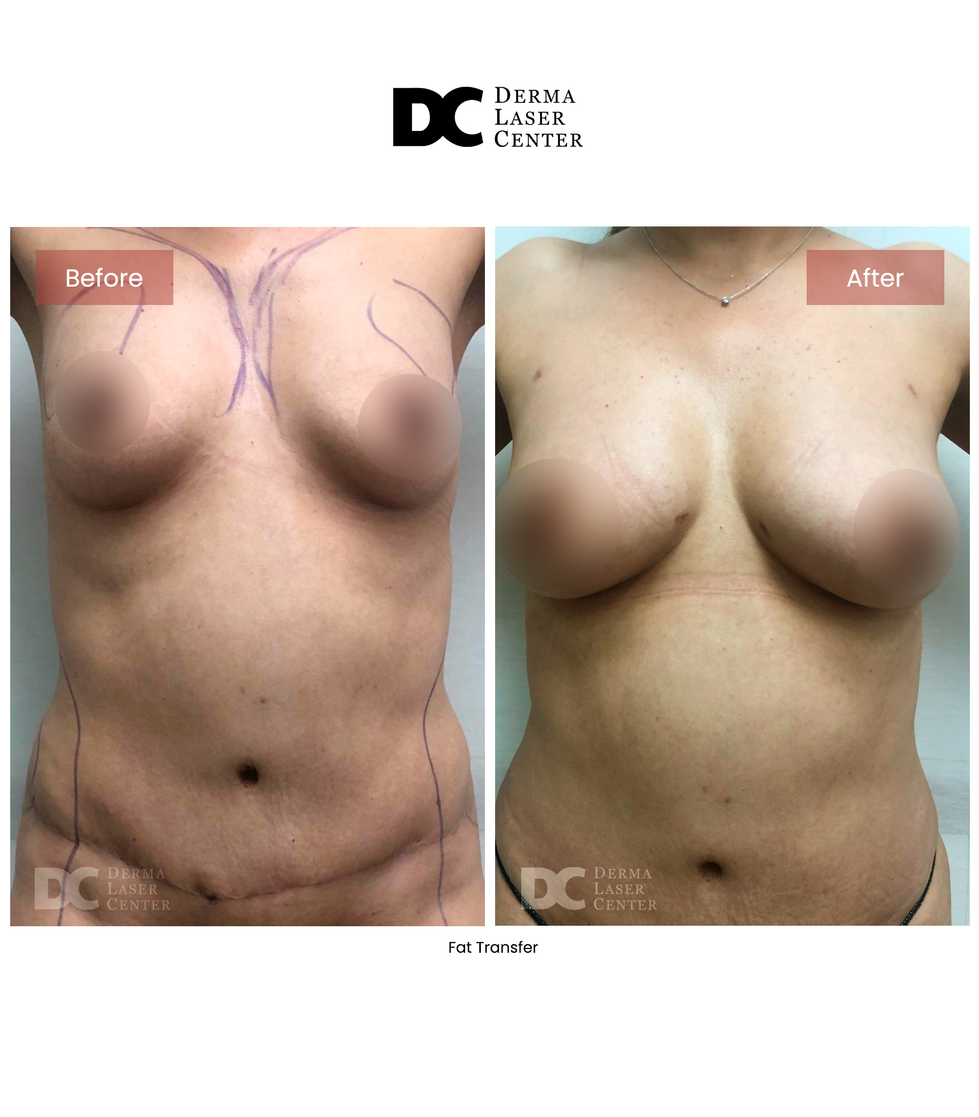 Fat transfer Image 69