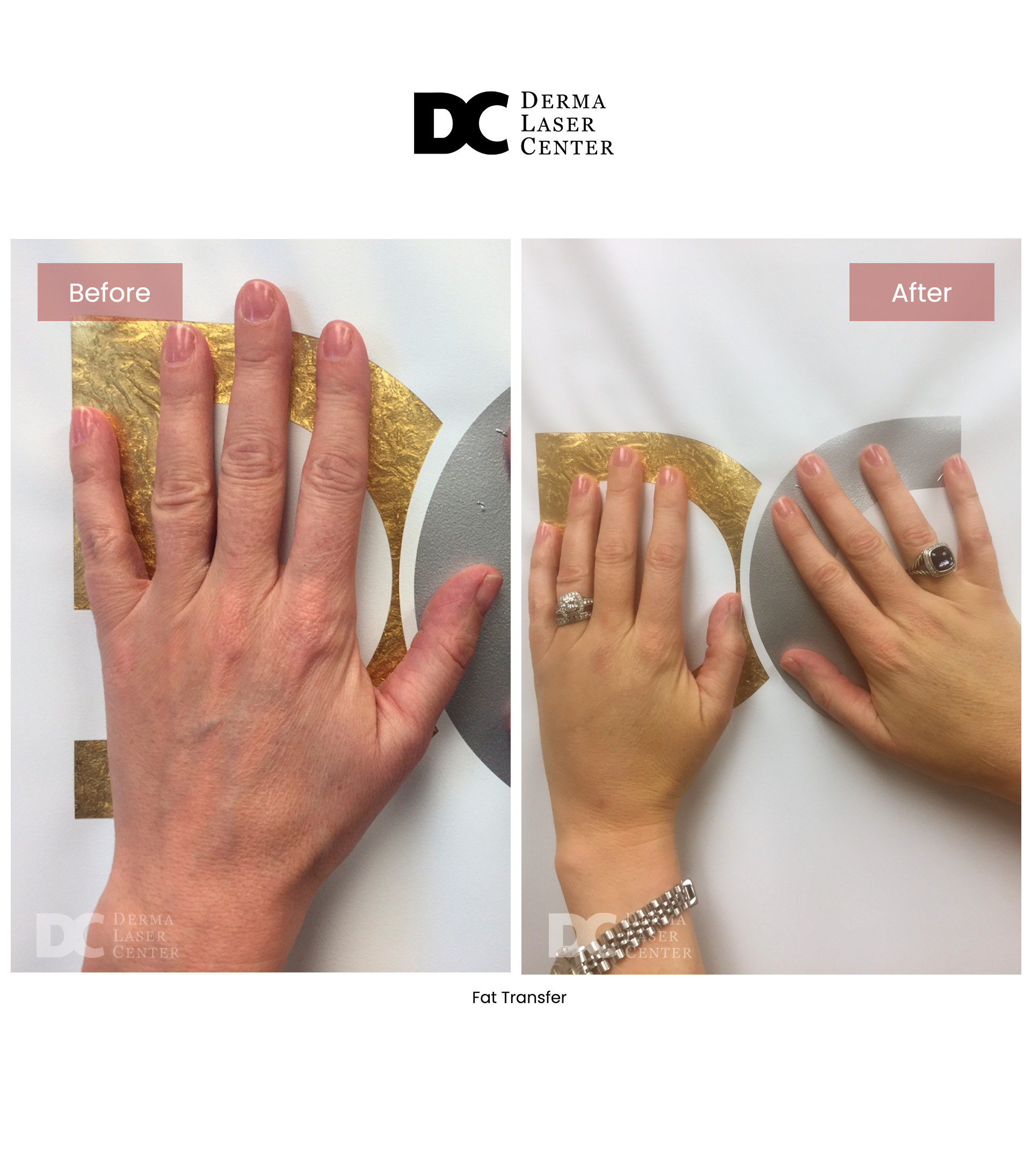 Fat Transfer image 72
