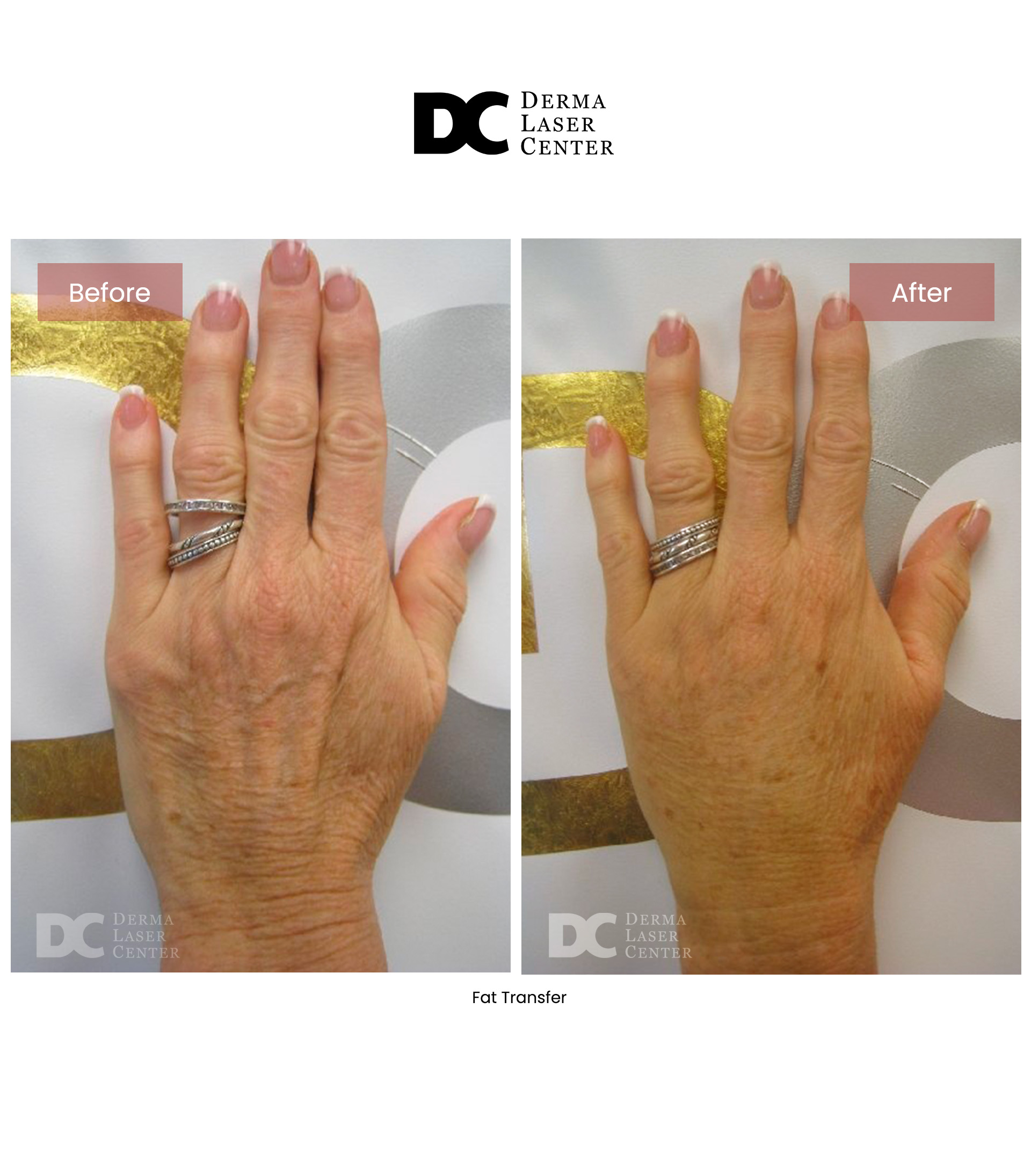 Fat Transfer image 74