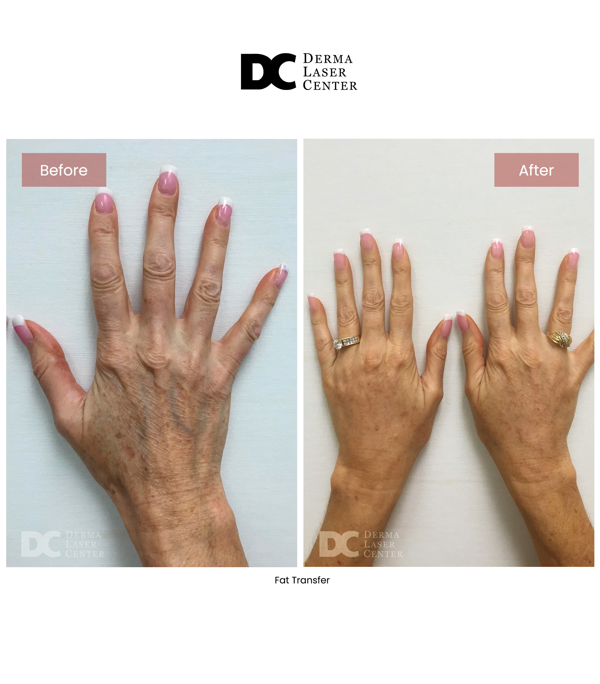 Fat Transfer image 77