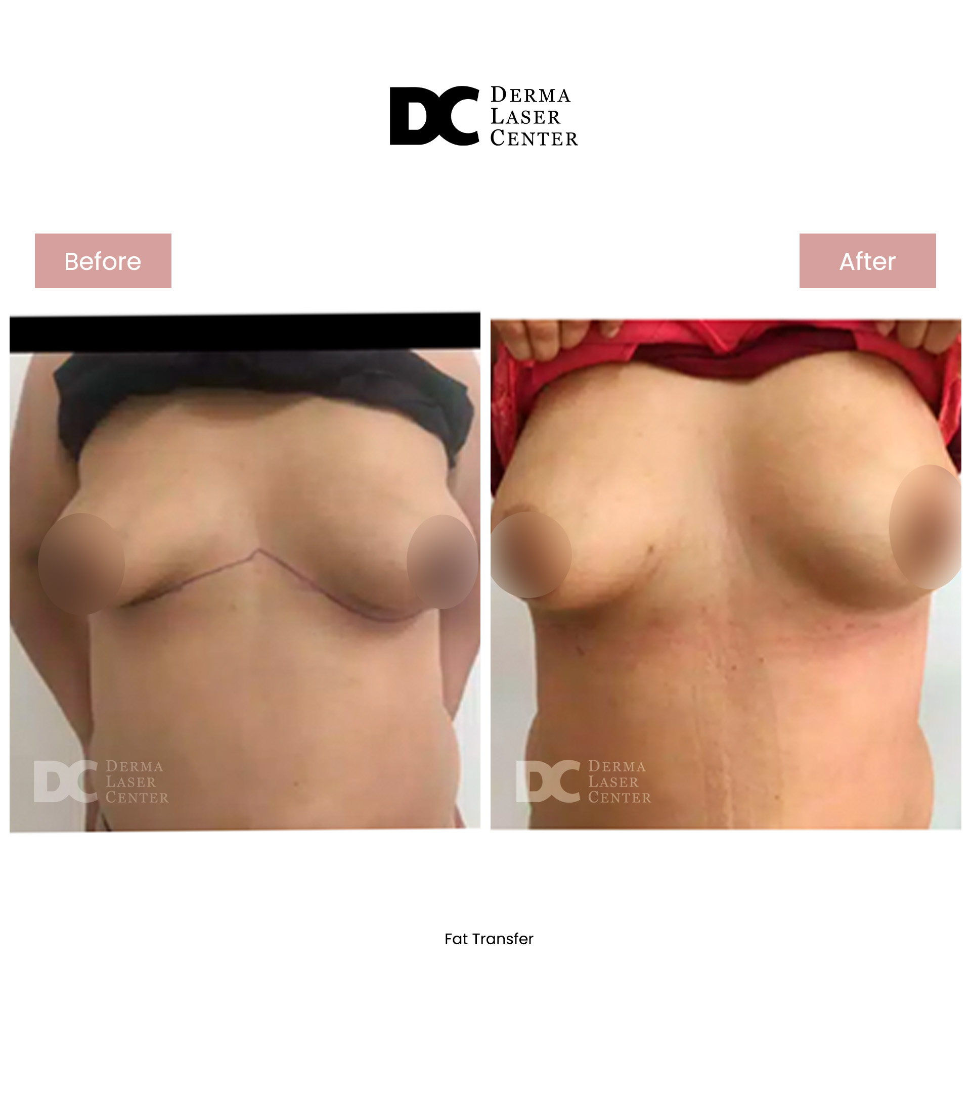 Fat transfer Image 78