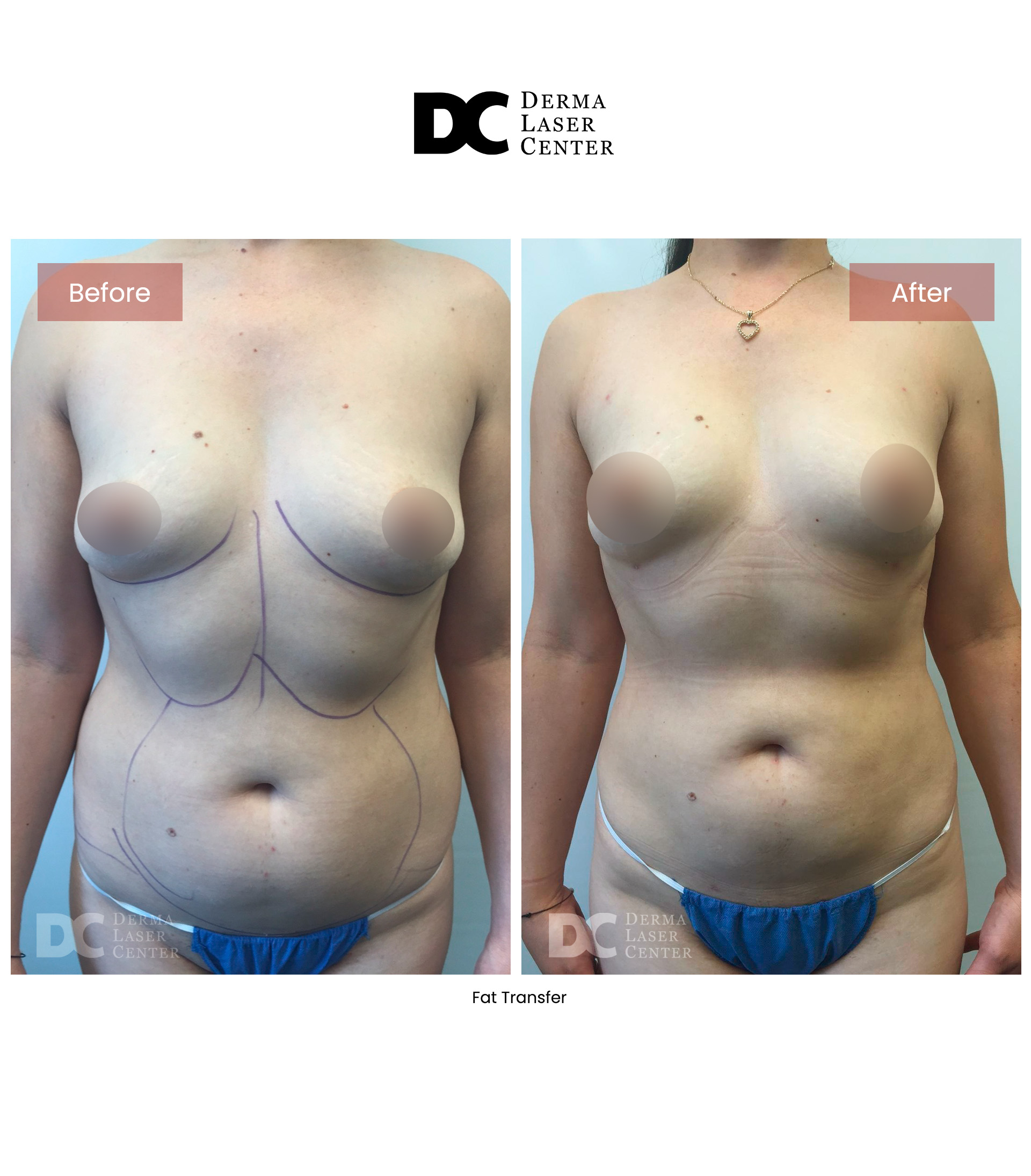 Fat transfer Image 80