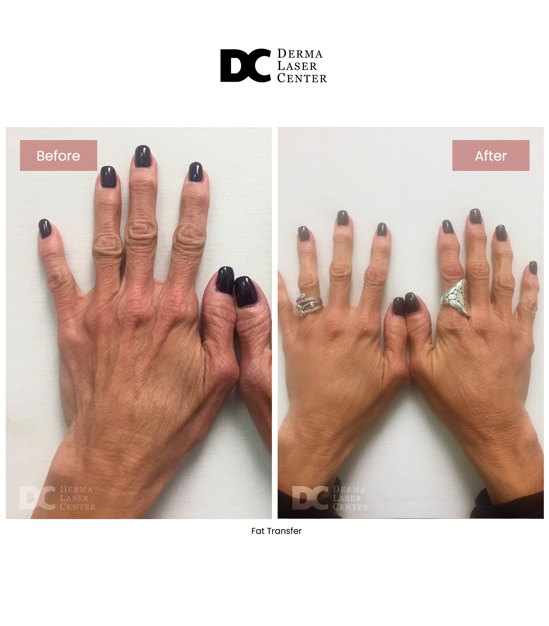 Fat Transfer image 82