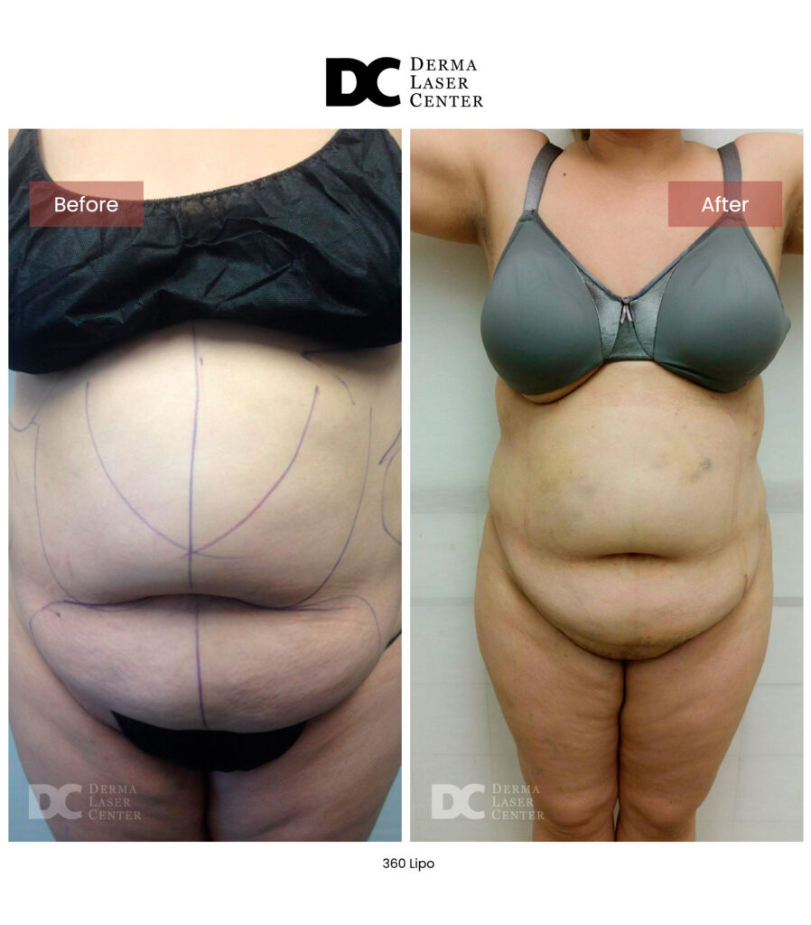 Lipo 360 image02