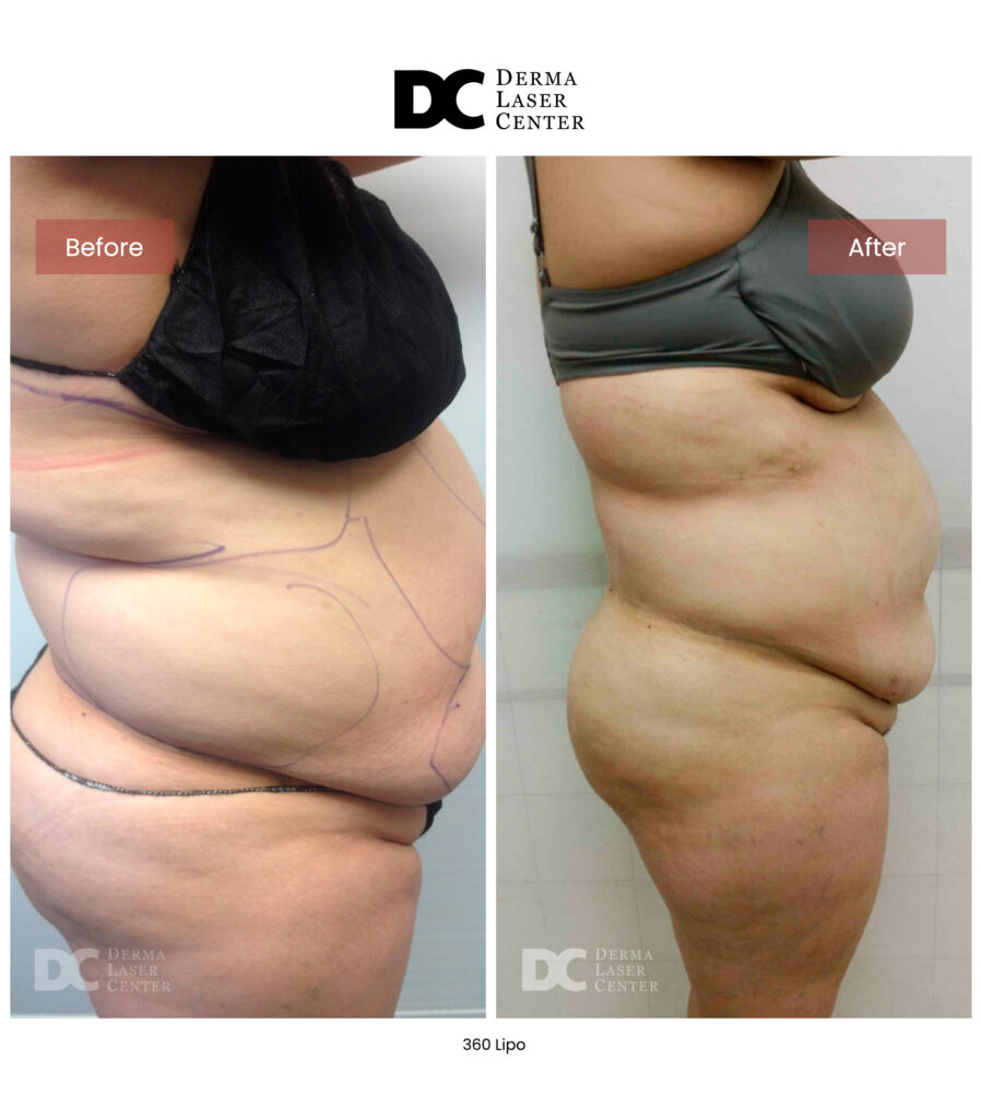 Lipo 360 image03