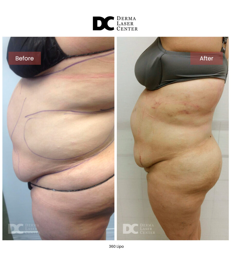 Lipo 360 image04