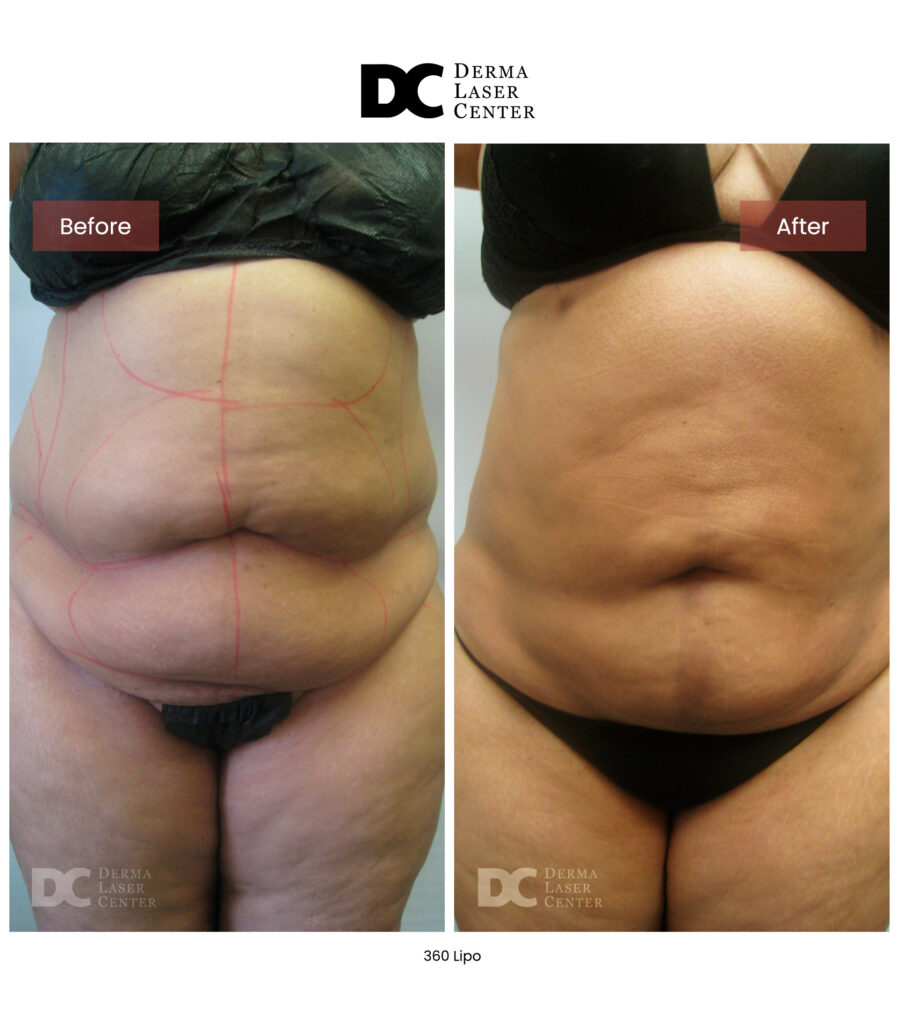 Lipo 360 image05