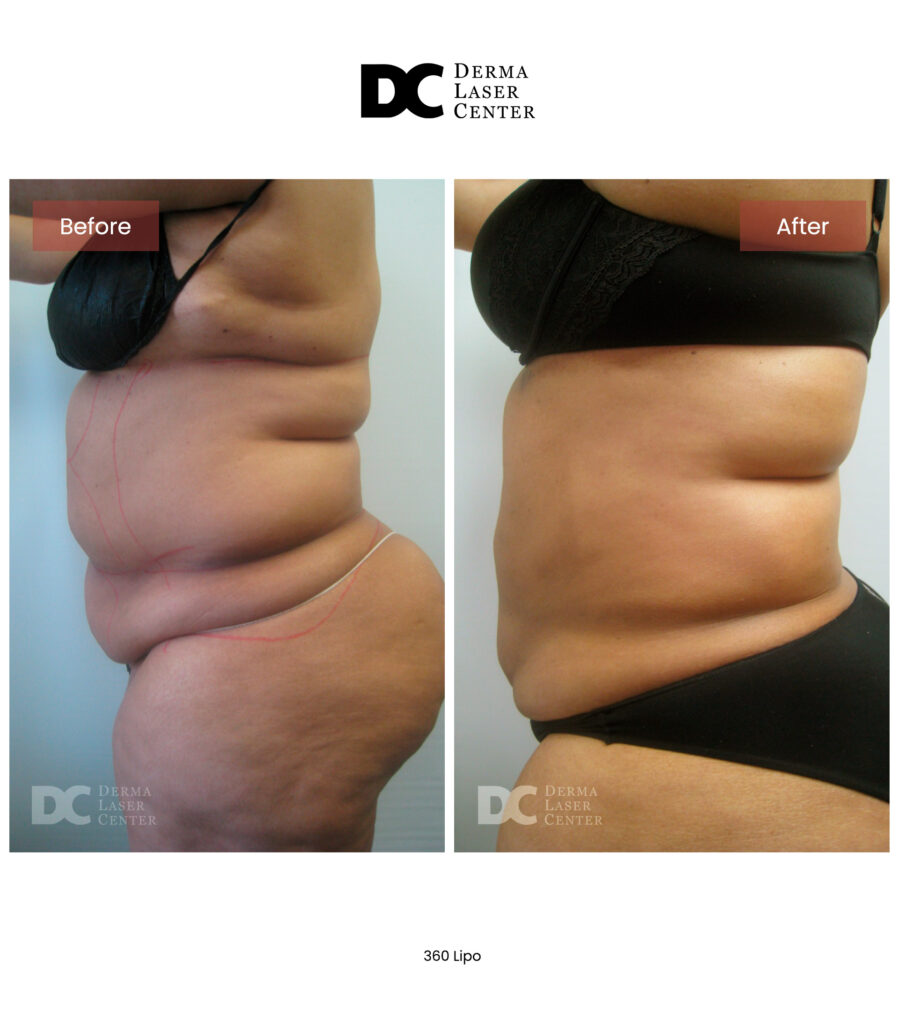 Lipo 360 image06