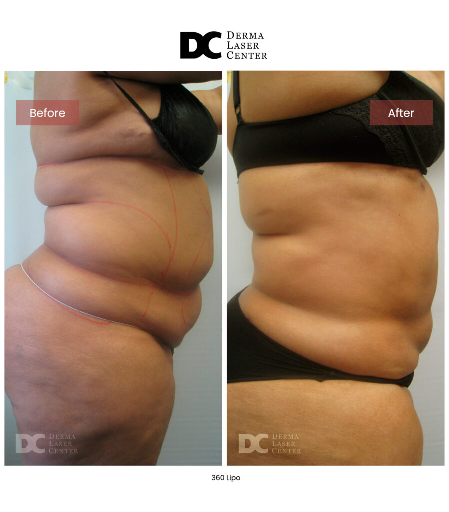 Lipo 360 image07