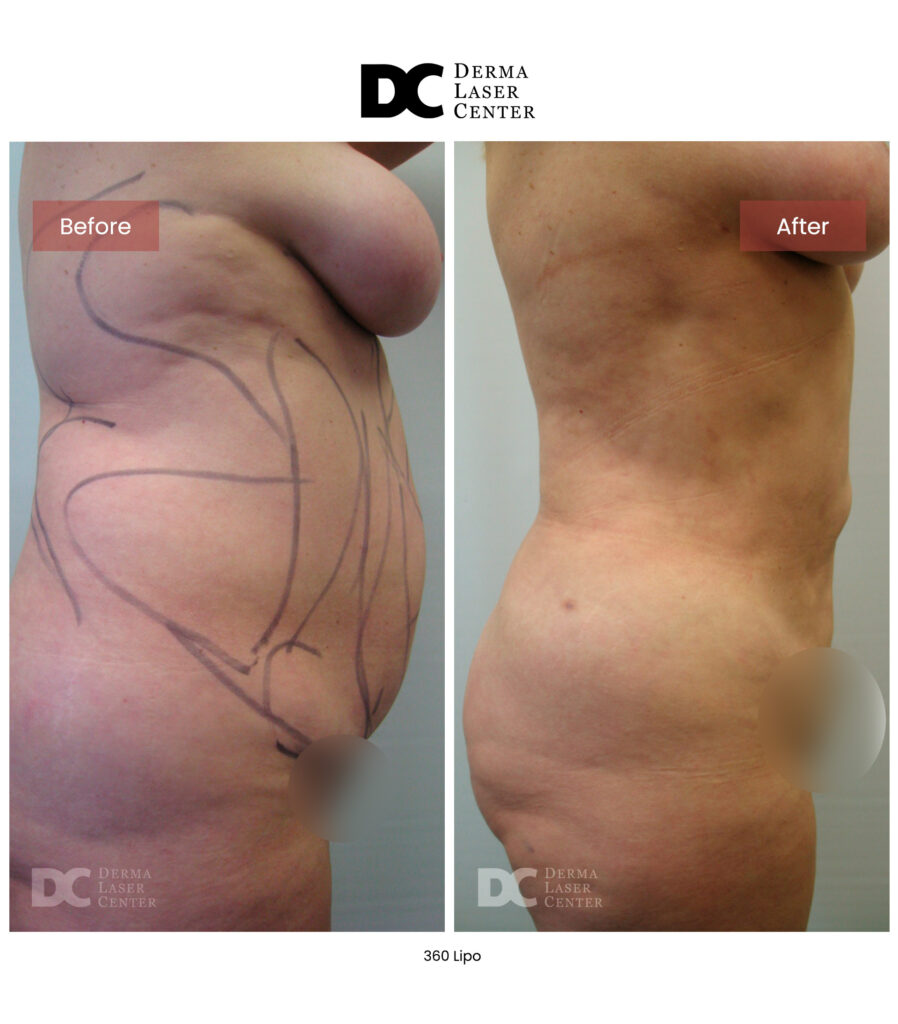 Lipo 360 image08