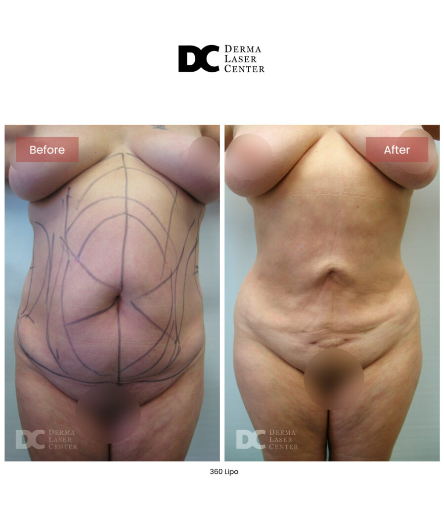 Lipo 360 image09