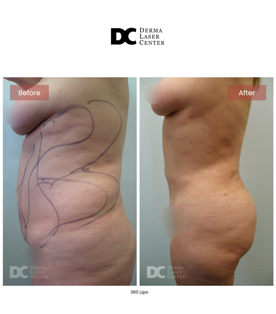 Lipo 360 image10
