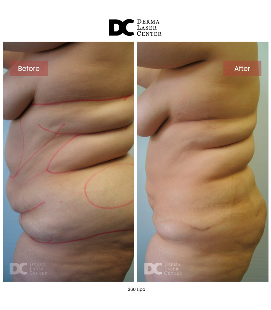 Lipo 360 image11