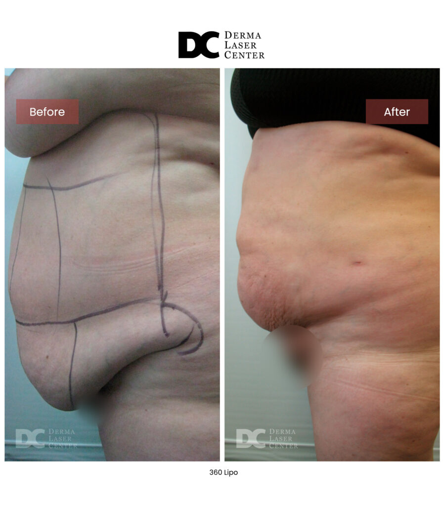 Lipo 360 image14 V1