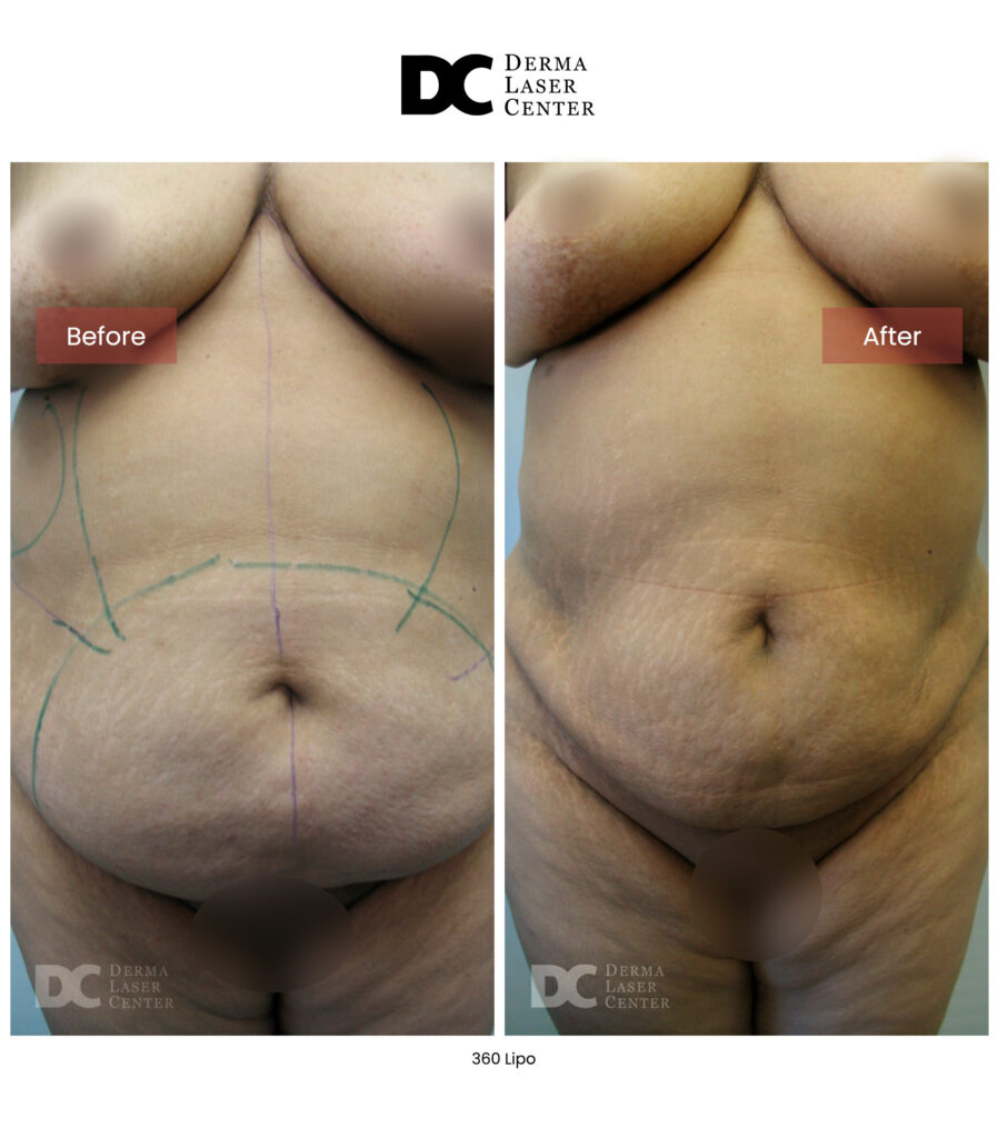 Lipo 360 image15 V1