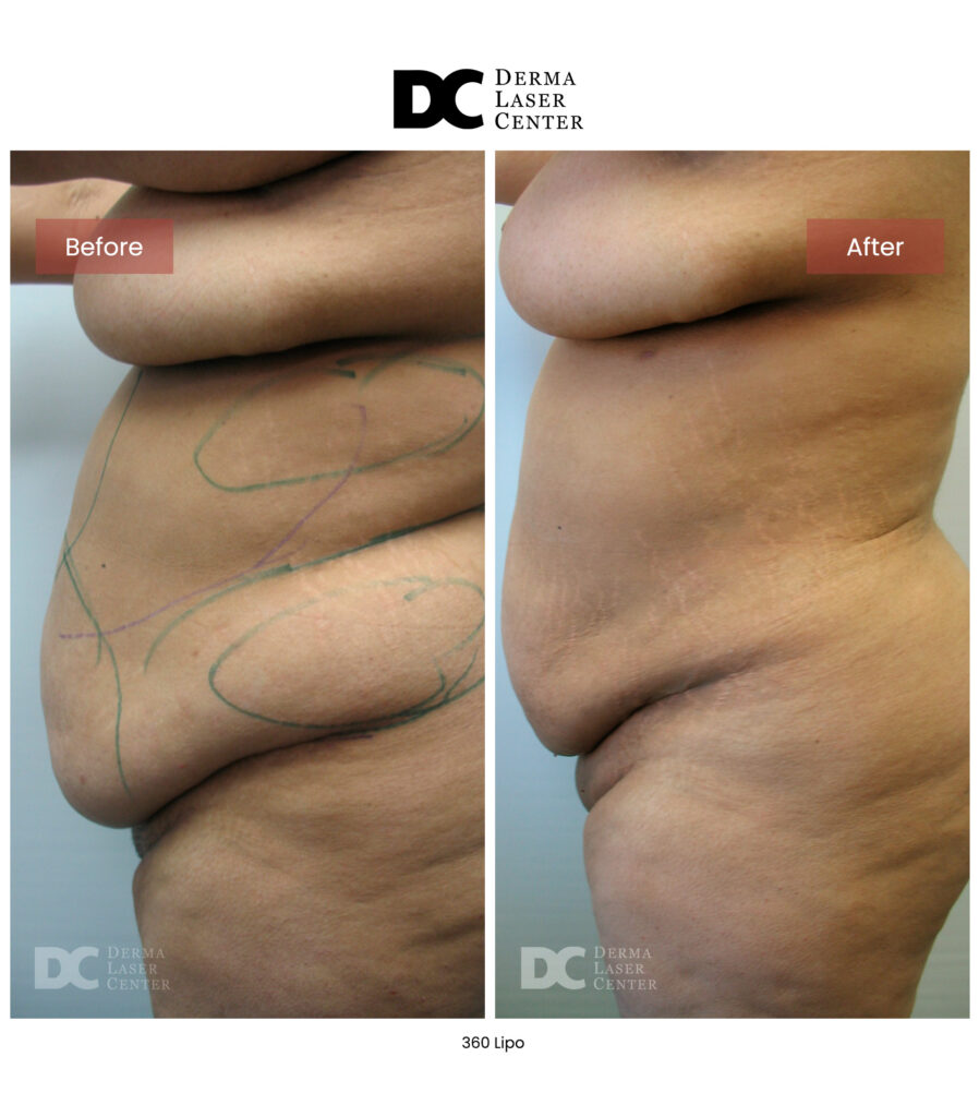 Lipo 360 image17 V1
