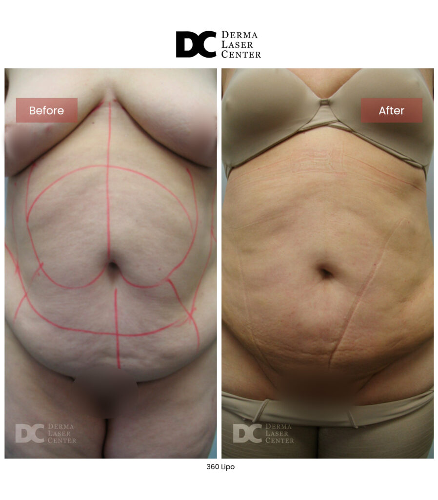 Lipo 360 image19 V1