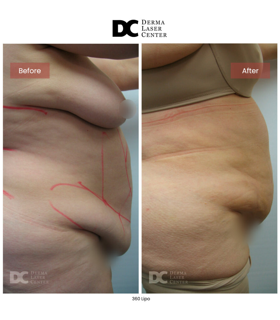 Lipo 360 image21 V1