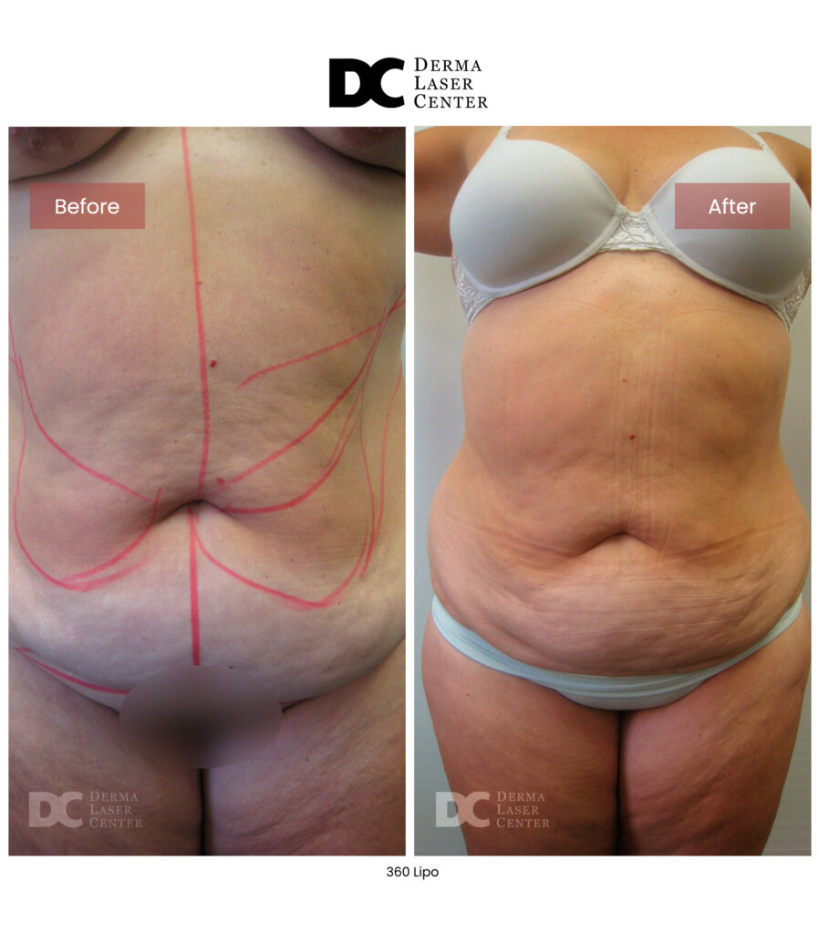 Lipo 360 image22 V1