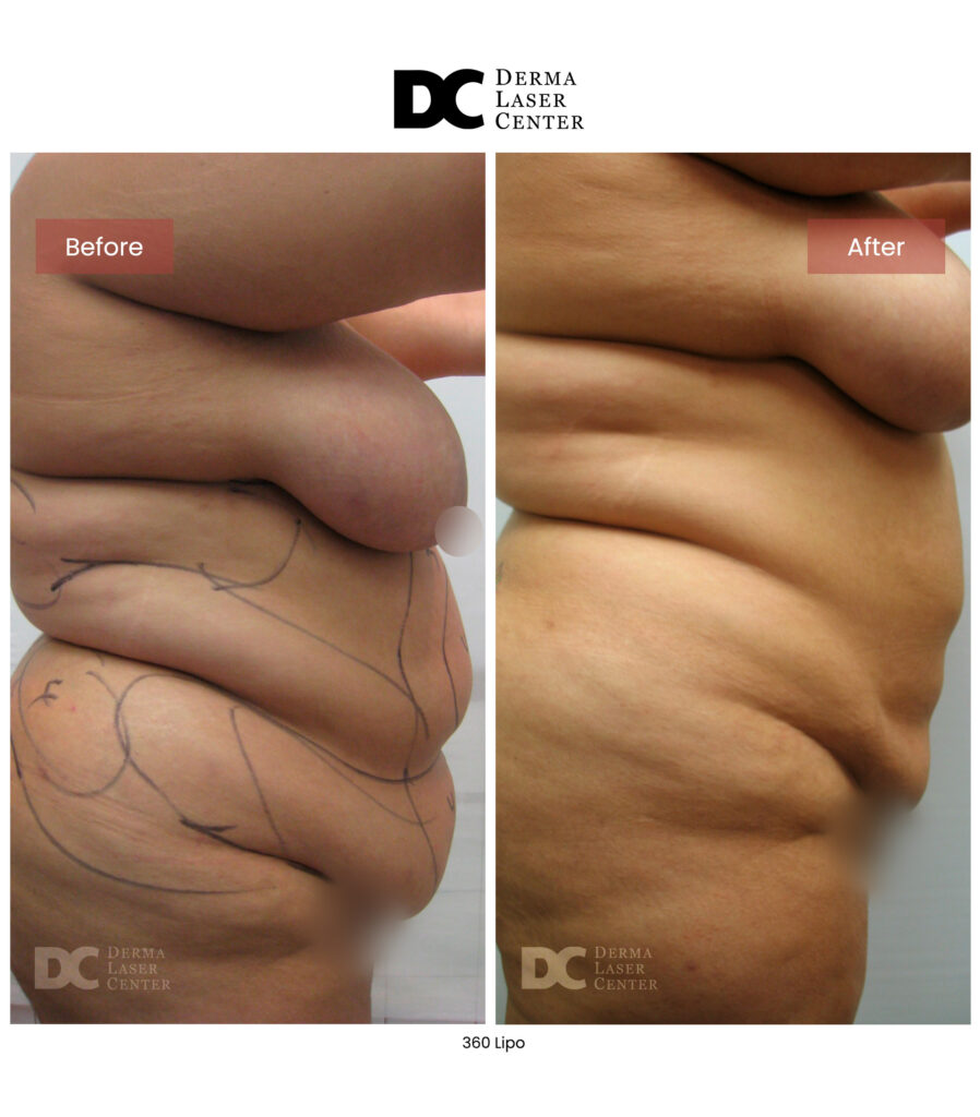 Lipo 360 image28 V1