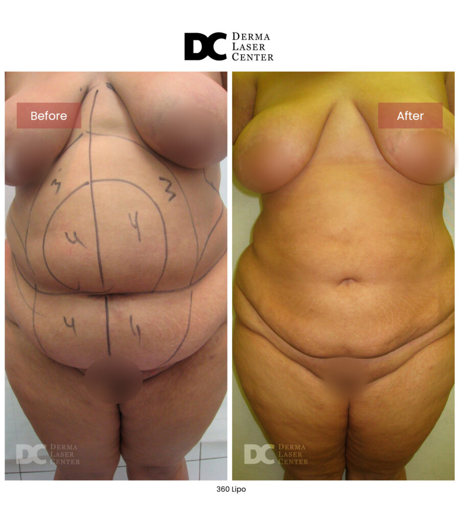 Lipo 360 image29 V1