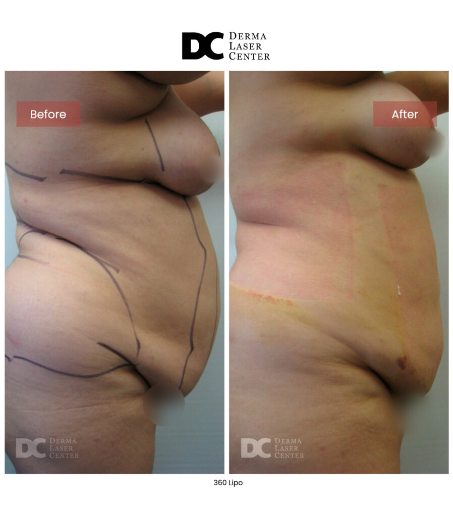 Lipo 360 image31 V1