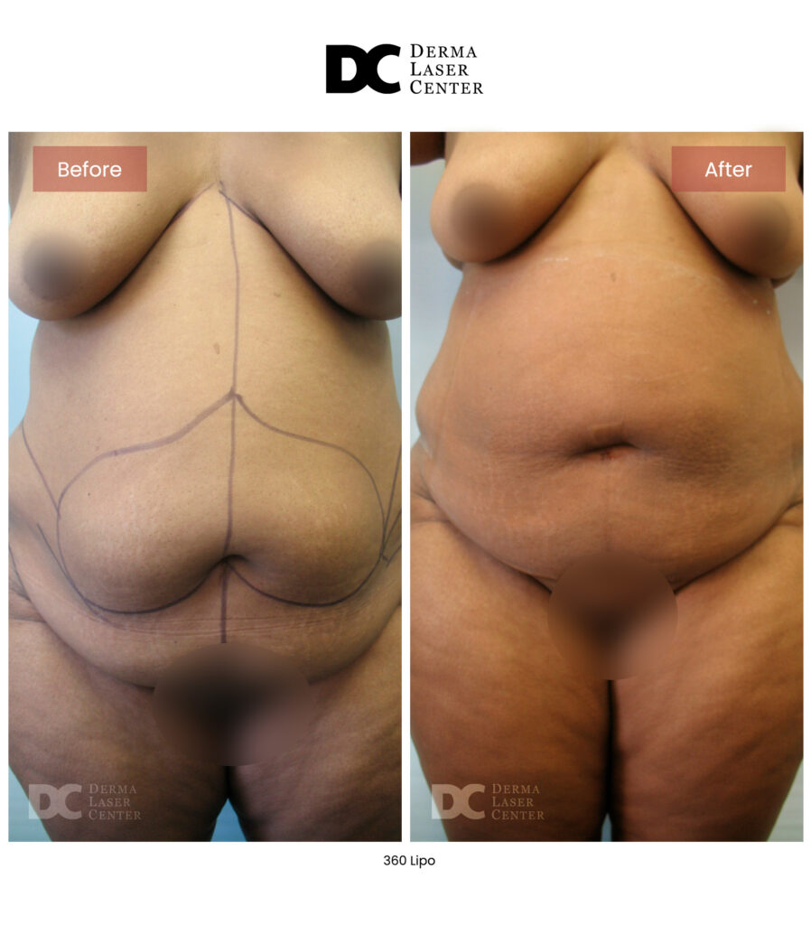 Lipo 360 image33 V1