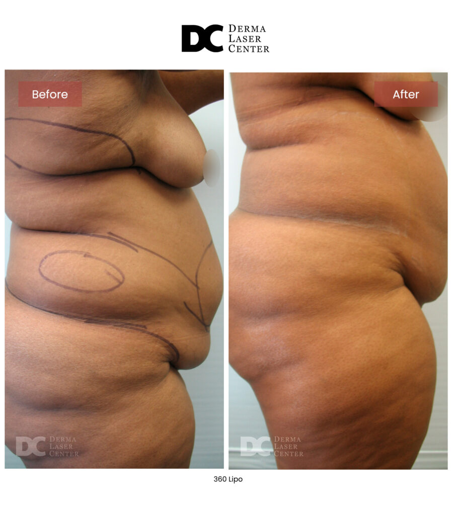 Lipo 360 image34 V1