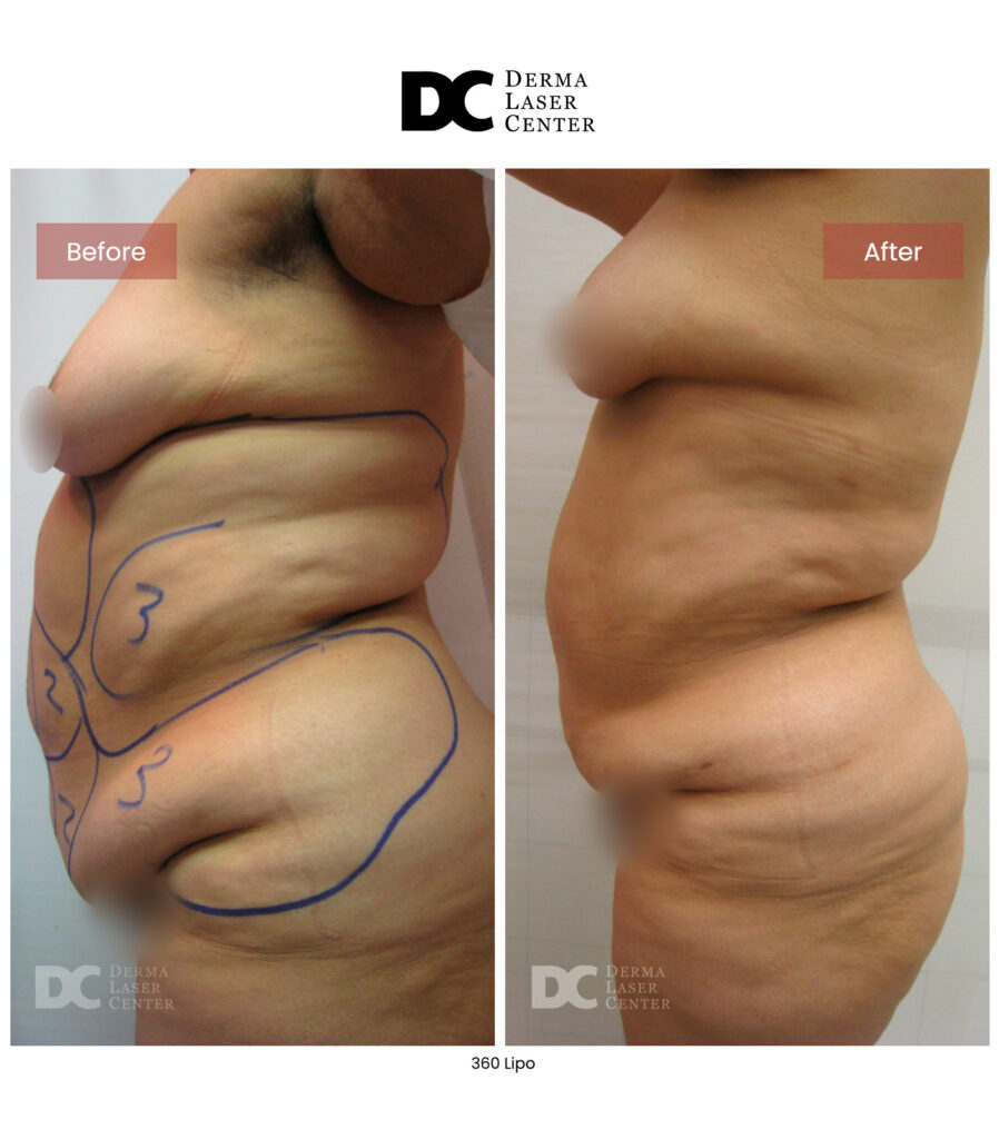 Lipo 360 image37 V1