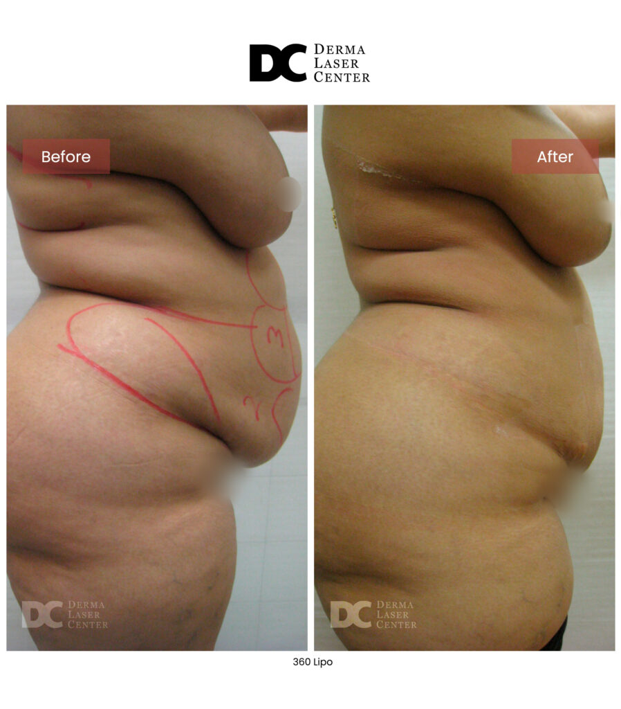 Lipo 360 image39 V1
