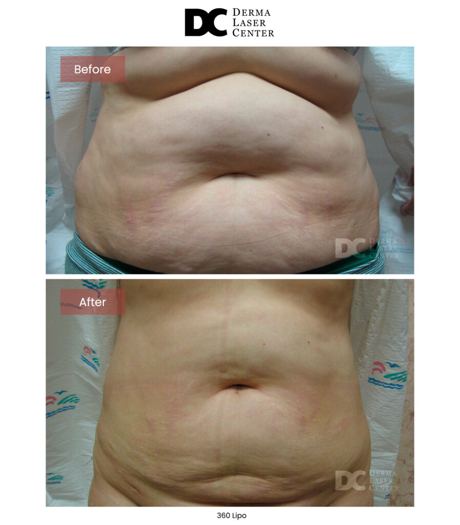 Lipo 360 image46 V1