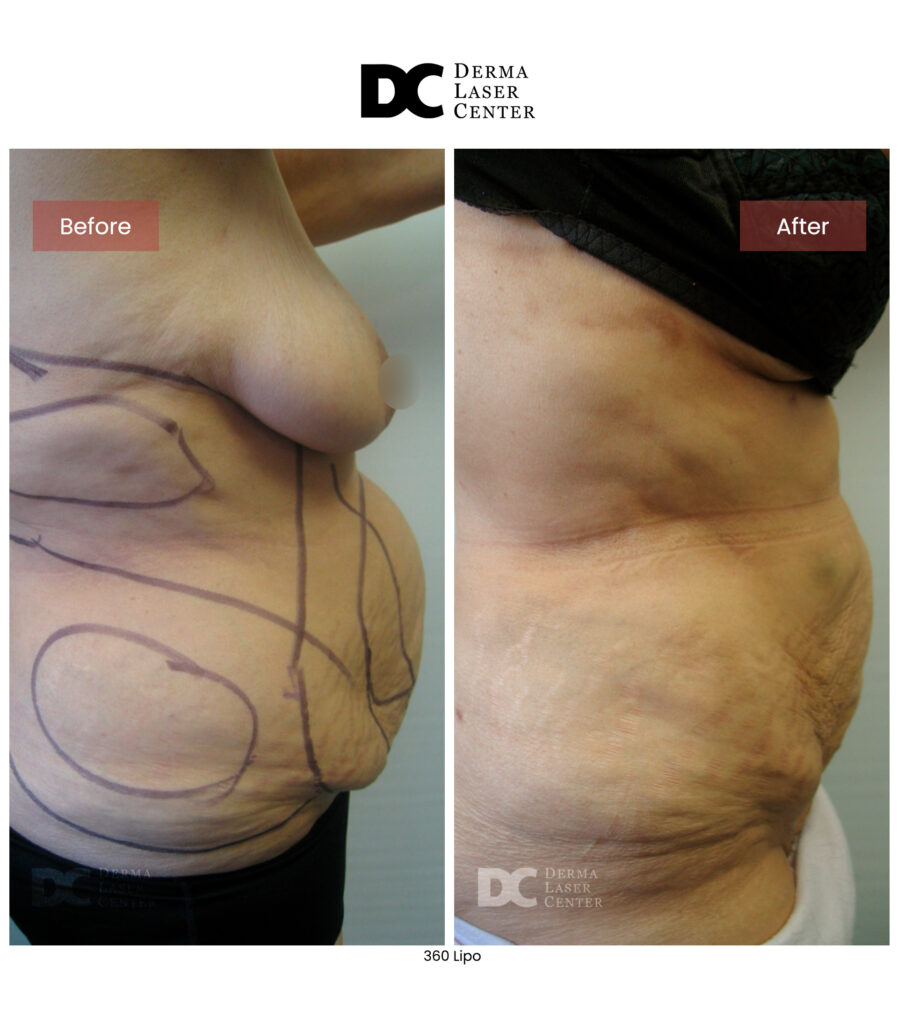 Lipo 360 image52 V1