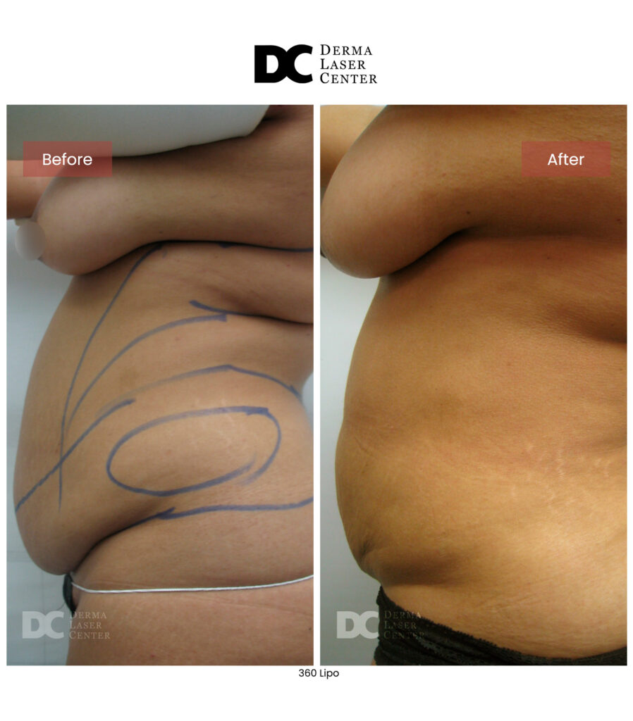 Lipo 360 image53 V1