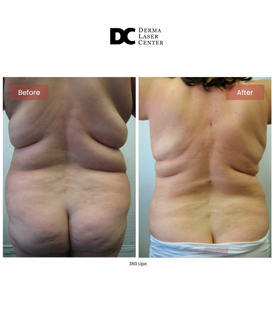 Lipo 360 image54