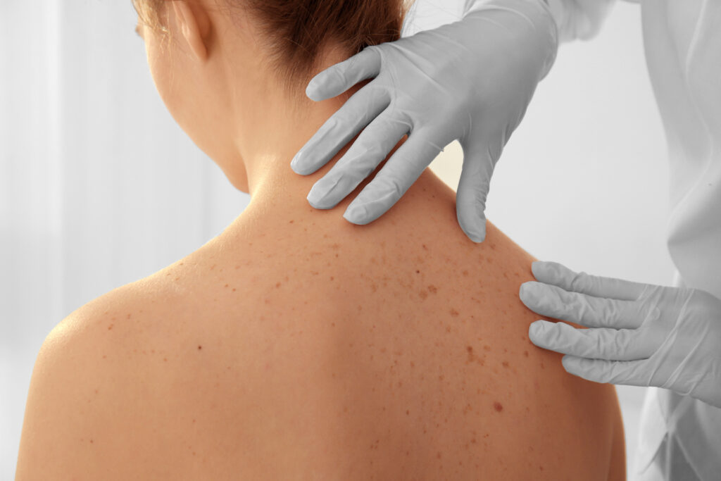 Dermatologist examining patient in clinic, closeup