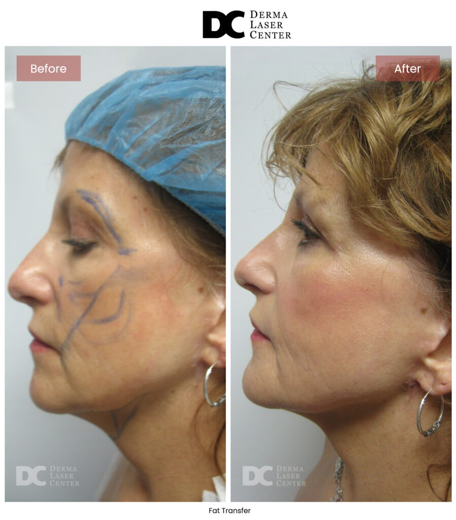 before after fat transfer face 19