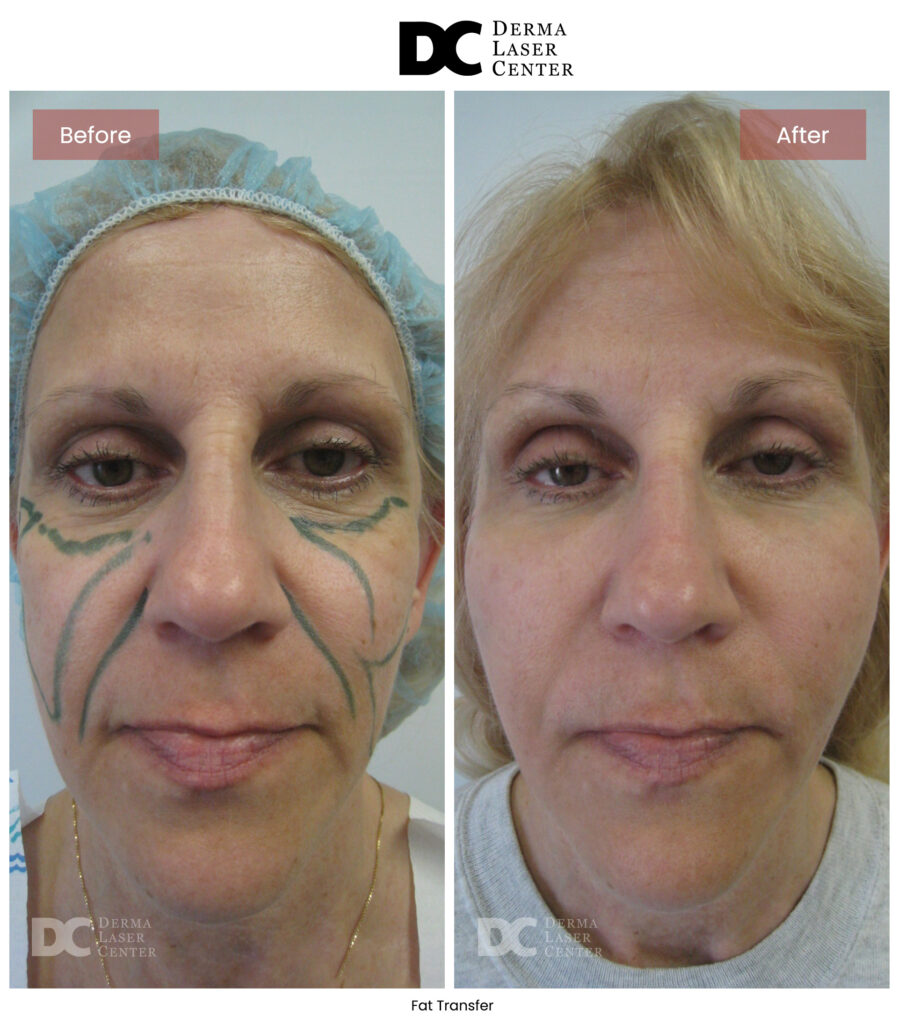 before after fat transfer face 21