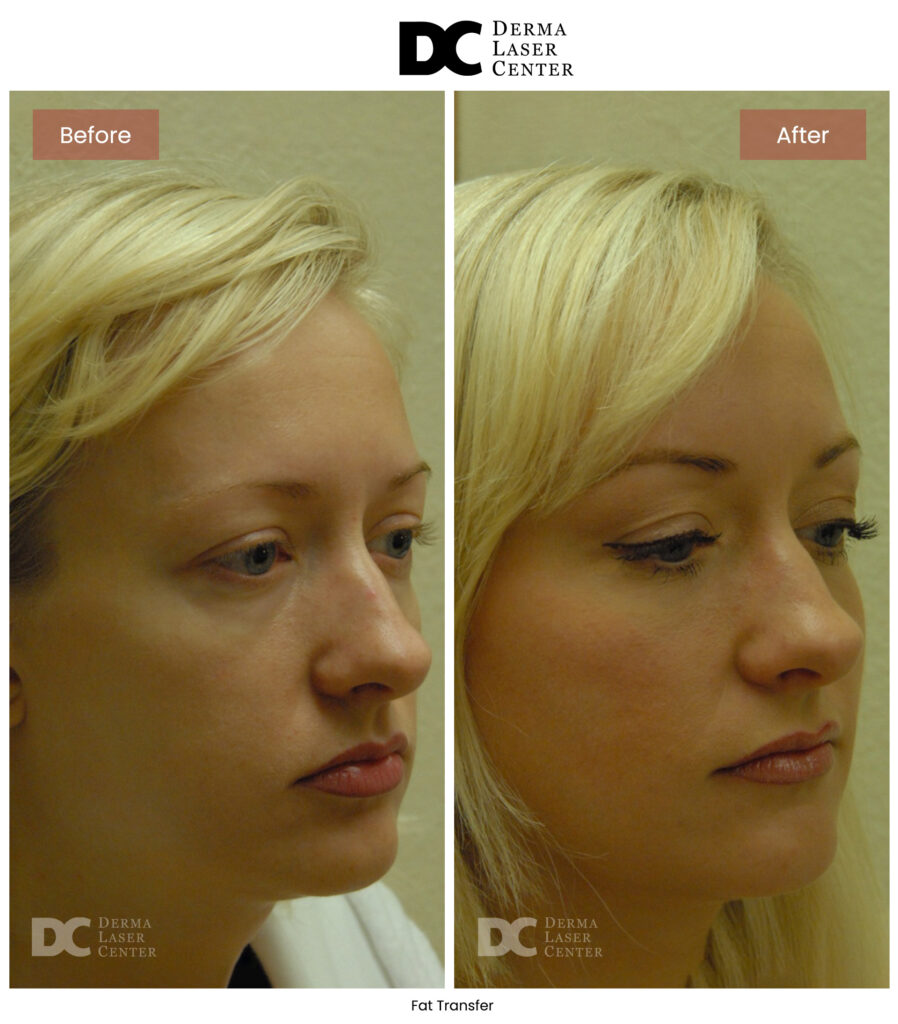 before after fat transfer face 3