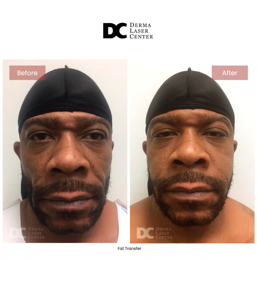before after fat transfer face 30
