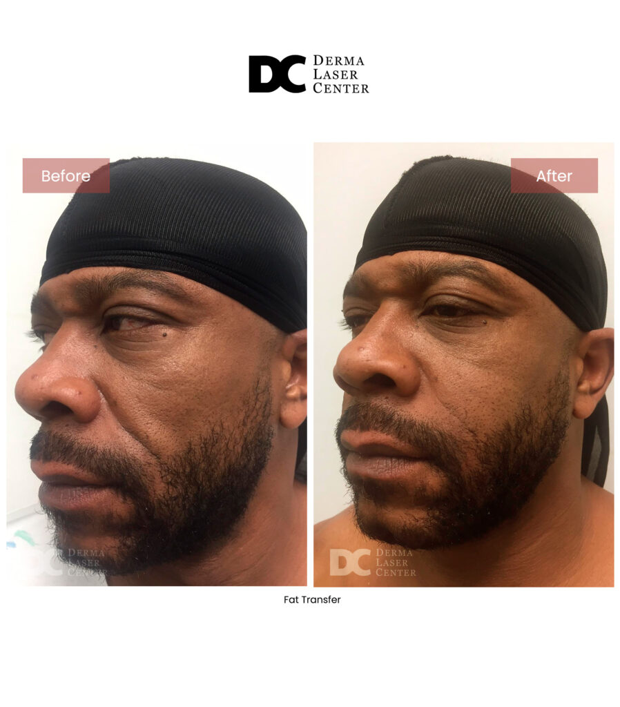 before after fat transfer face 31