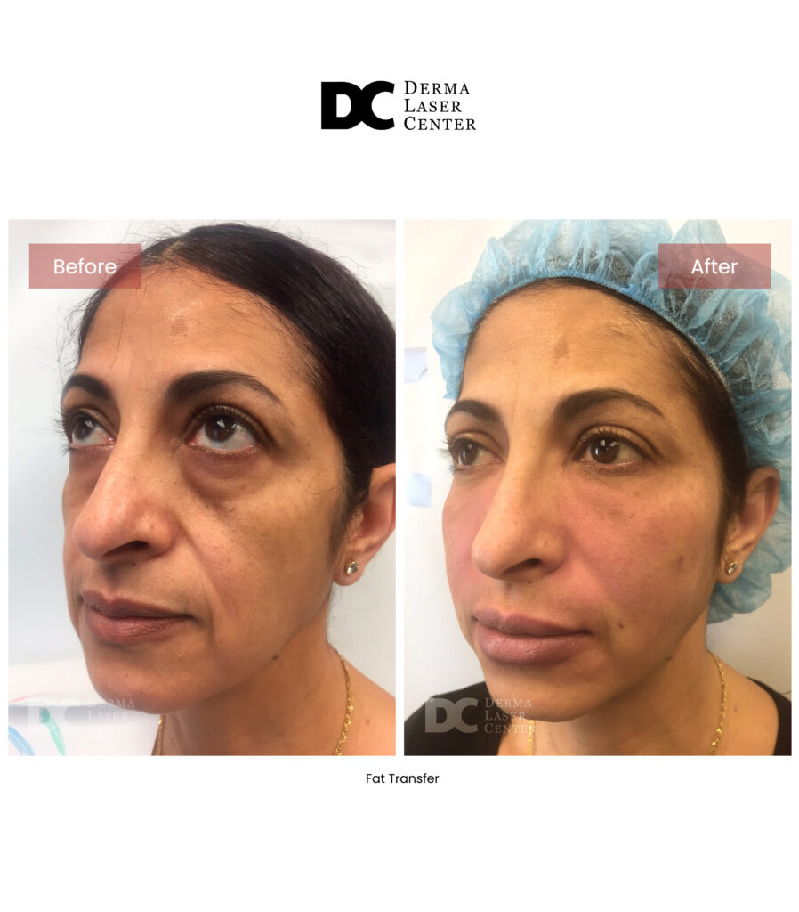 before after fat transfer face 34