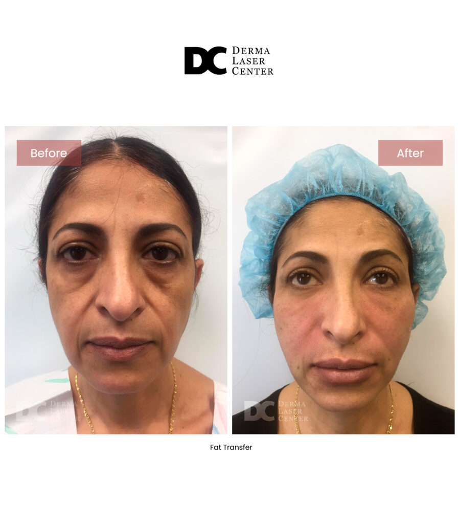 before after fat transfer face 35