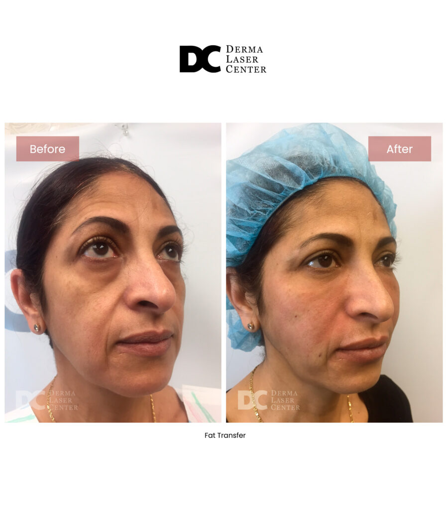 before after fat transfer face 36