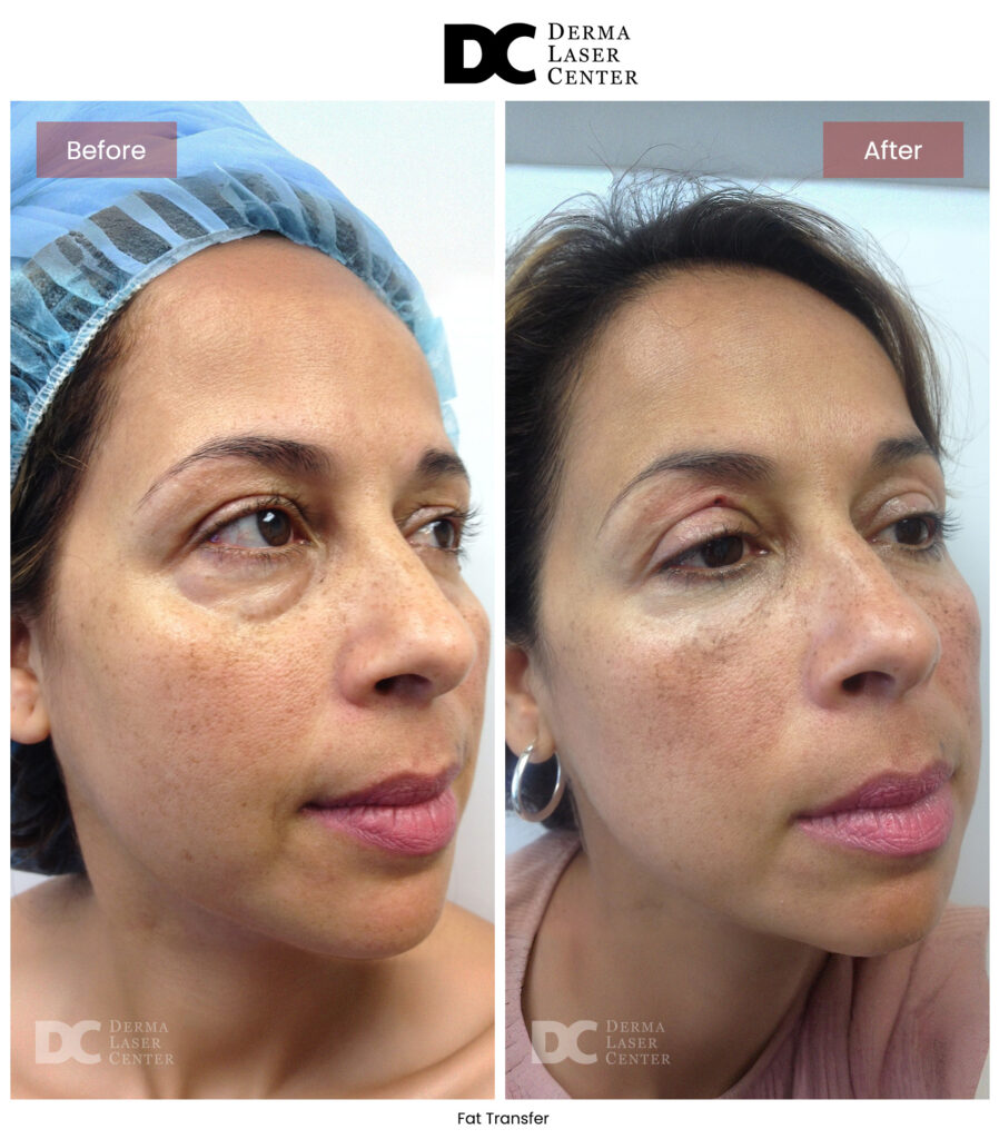 before after fat transfer face 4