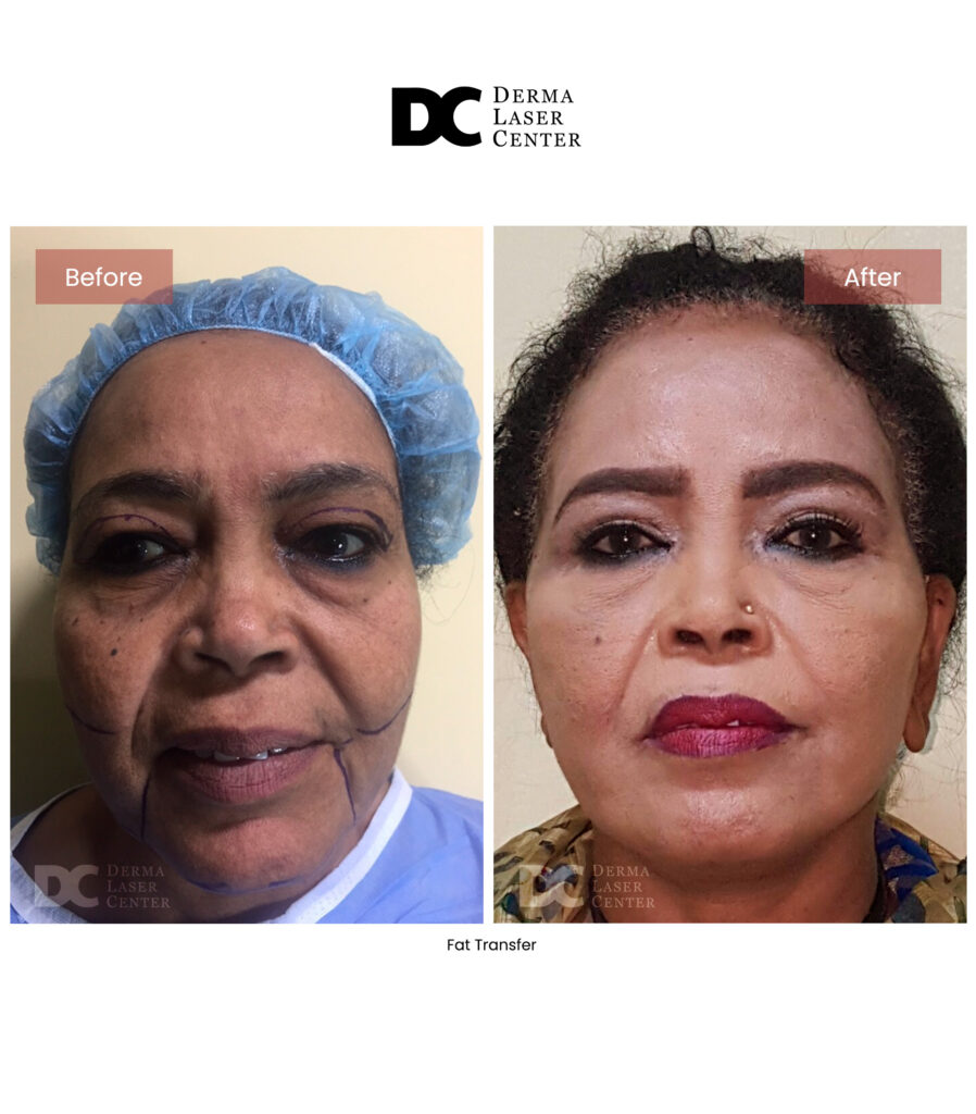 before after fat transfer face 6