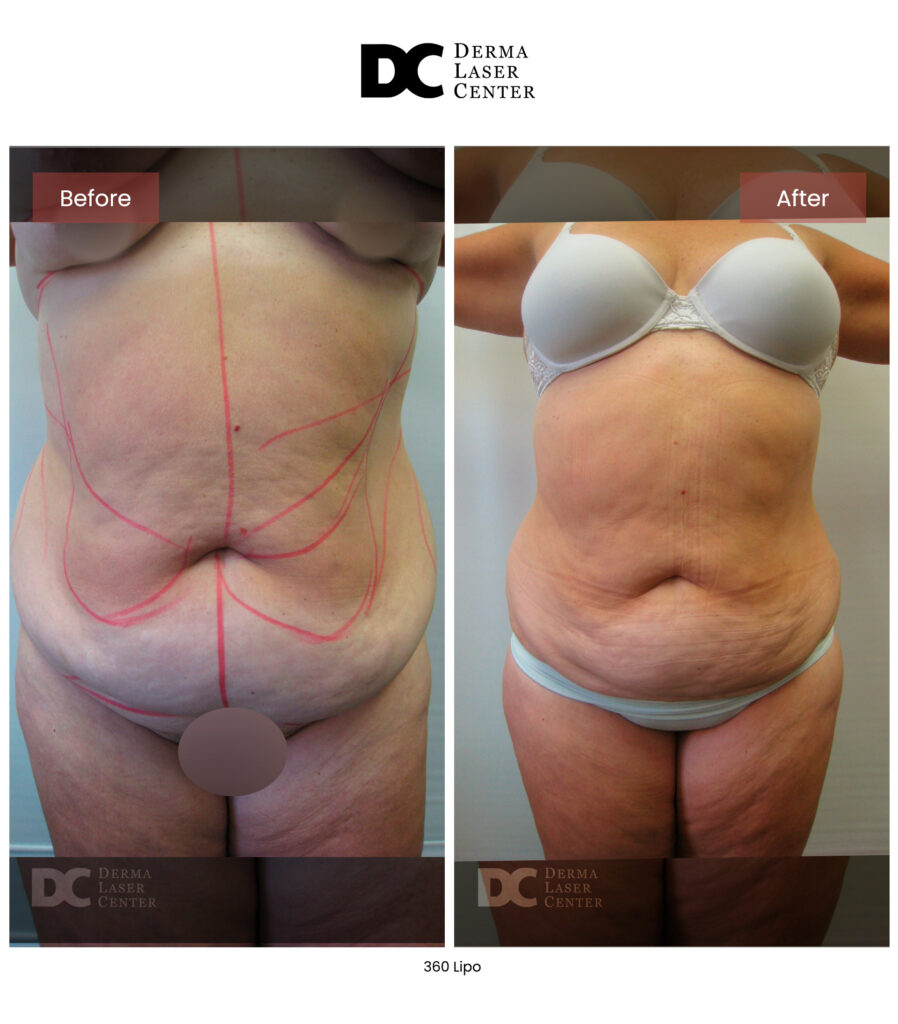 before after lipo 360 10