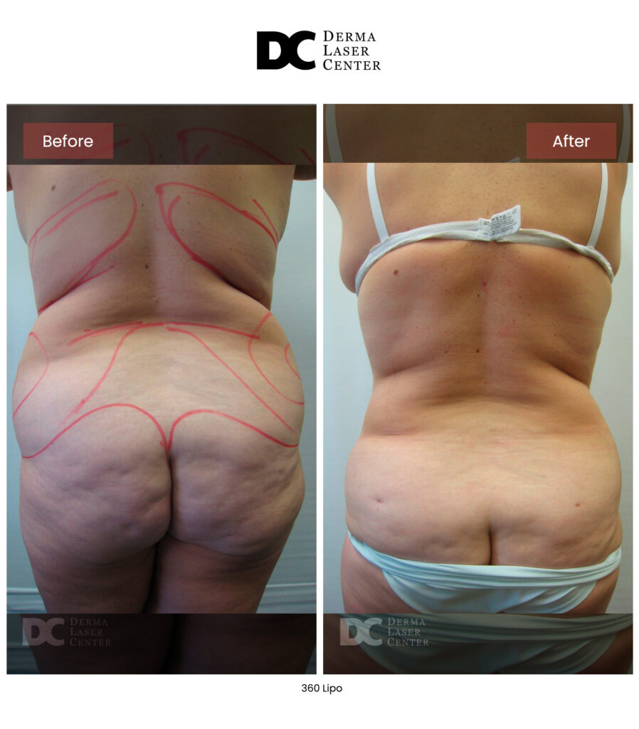 before after lipo 360 11