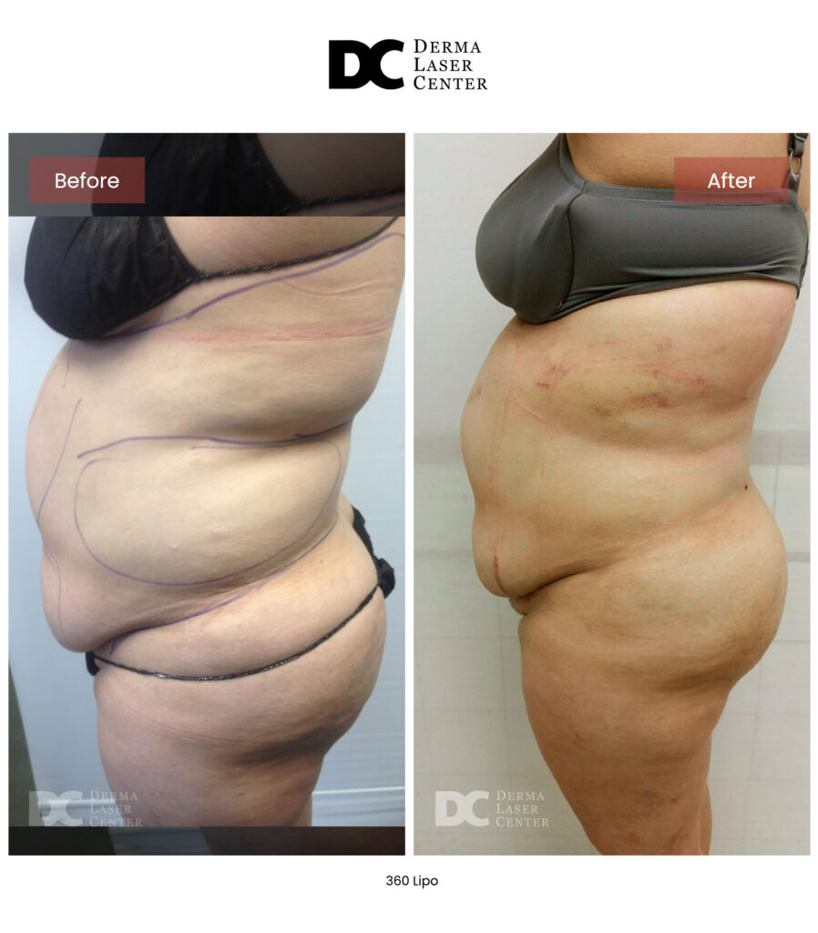 before after lipo 360 12